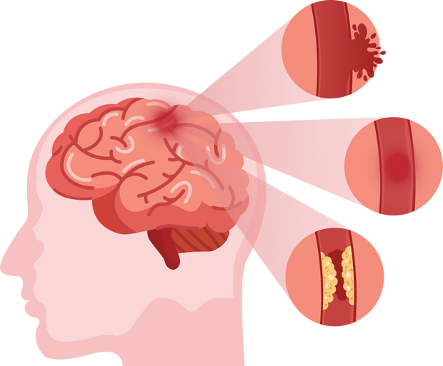 Stroke disease. Hemorrhagic brain stroke concept. Apoplexy,